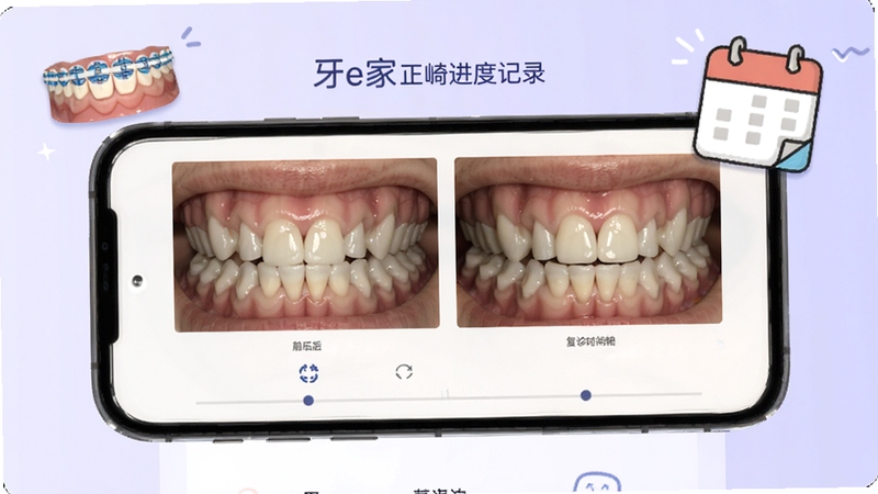 牙e家正畸进度记录页面,手机屏幕中展示牙齿矫正前后对比照片和复诊时间轴,背景为淡紫色渐变,画面中有牙套和日历的卡通图标,整体风格简洁实用